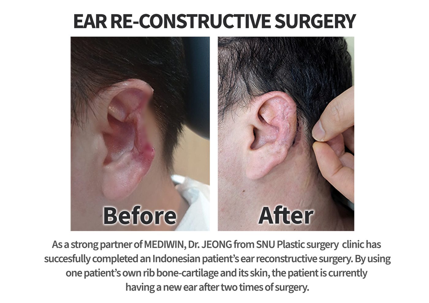 Before and after ear reconstruction surgery using the patient’s own rib cartilage — MEDIWIN case at a partner clinic in Seoul