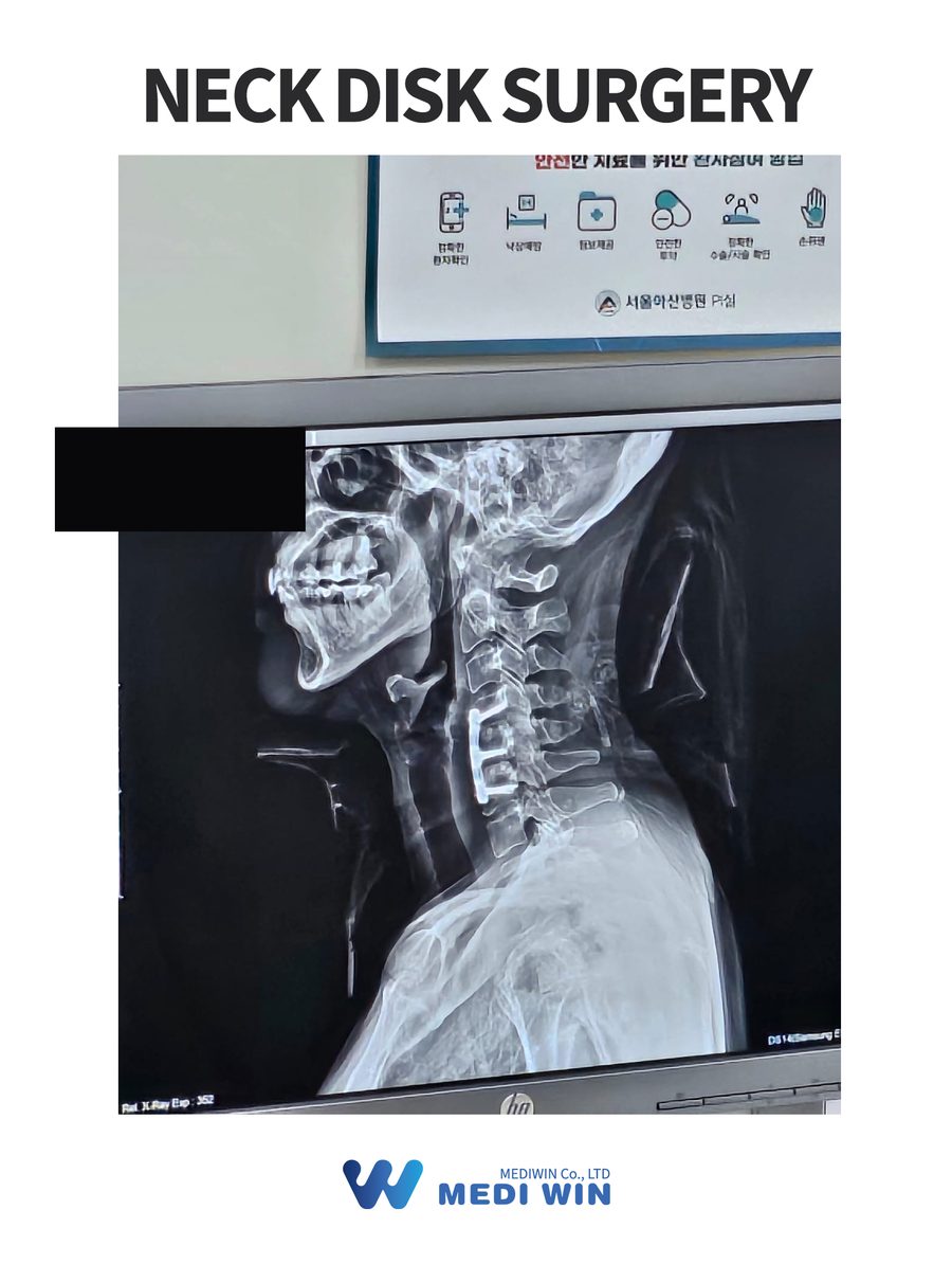 Post-surgery cervical spine X-ray after neck disc surgery at Asan Medical Center — patient identifiers masked