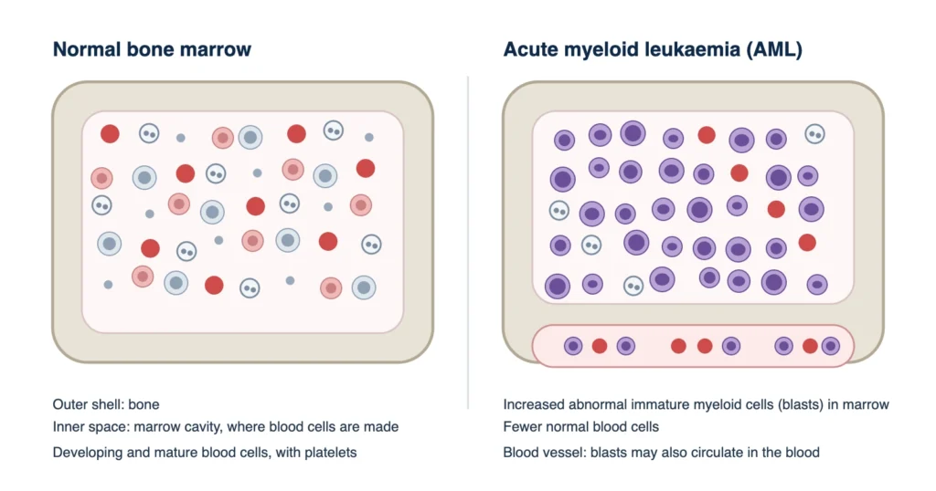 AML treatment in Korea: schematic comparing normal bone marrow with marrow containing increased immature myeloid blasts in acute myeloid leukaemia