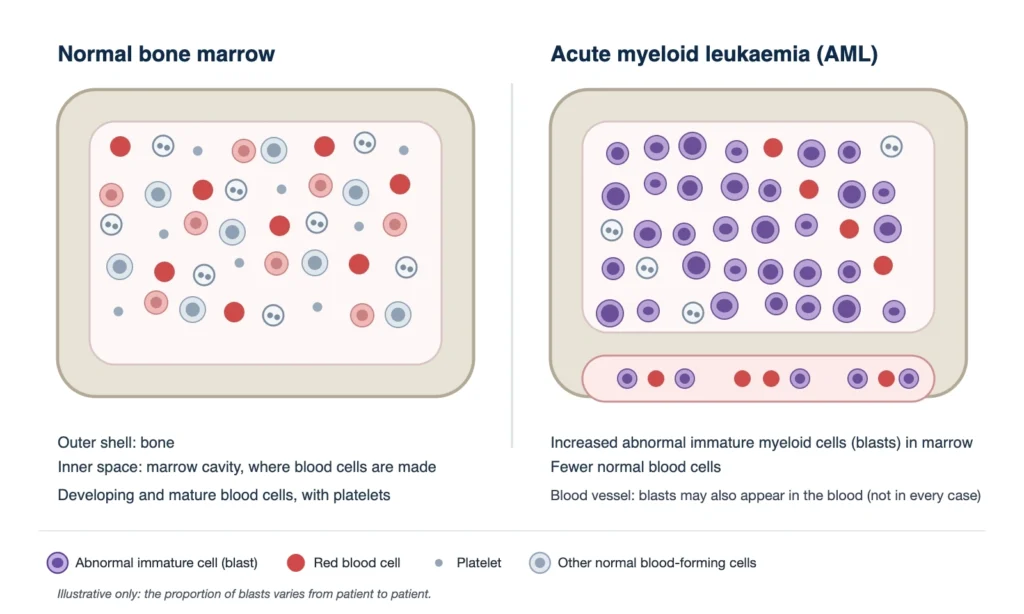 AML treatment in Korea: schematic comparing normal bone marrow with marrow containing increased immature myeloid blasts in acute myeloid leukaemia