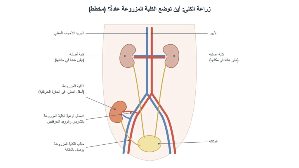مخطط لموضع الكلية المزروعة في أسفل البطن مع بقاء الكليتين الأصليتين عادةً في مكانهما