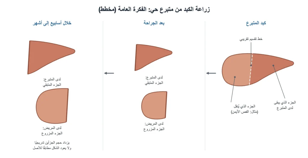 مخطط مبسّط لفكرة زراعة الكبد من متبرع حي وازدياد حجم الجزأين مع الوقت