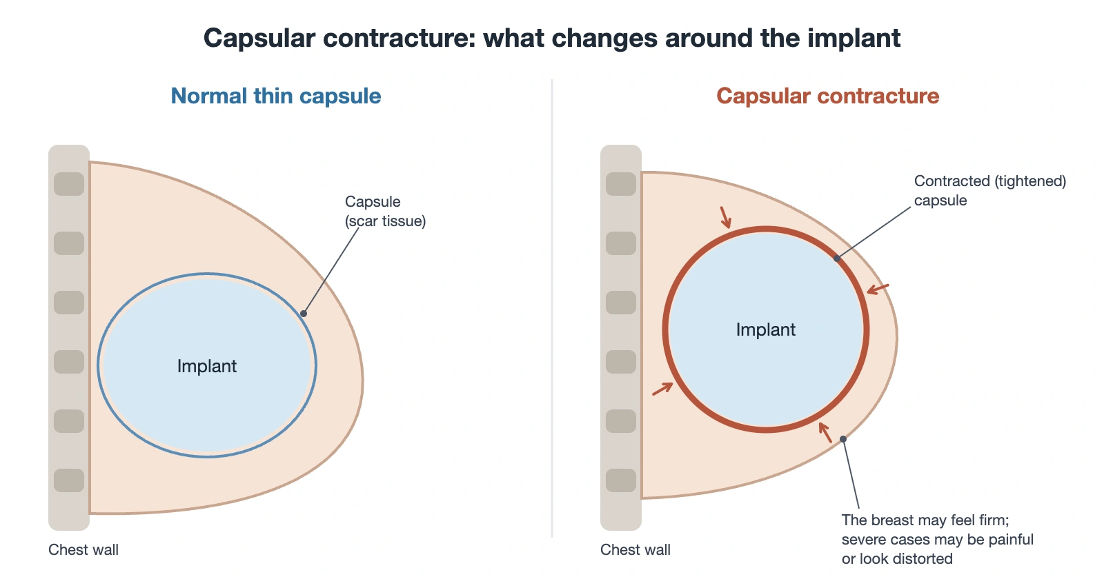Breast implant revision in Korea: schematic of a normal thin capsule versus capsular contracture around a breast implant