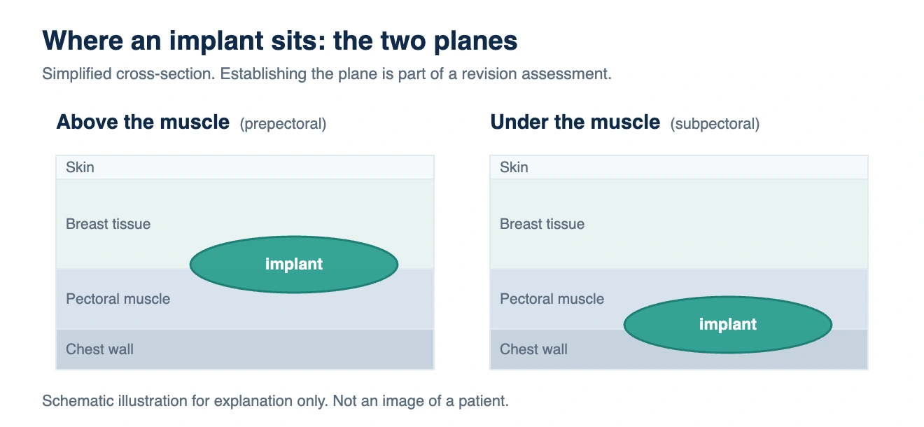 Breast implant revision in Korea: diagram of implant placement above and under the pectoral muscle