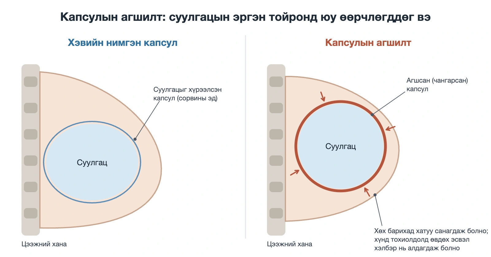 Хөхний суулгацын дахин мэс засал: хэвийн нимгэн капсул ба капсулын агшилтын бүдүүвч зураг