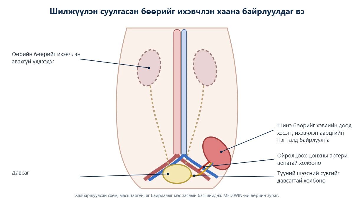 Бөөр шилжүүлэн суулгалтын схем: шинэ бөөрийг хэвлийн доод хэсэгт аарцгийн нэг талд байрлуулж, цонхны артери, венатай холбож, шээсний сувгийг давсагтай холбосон; өөрийн бөөр үлдсэн