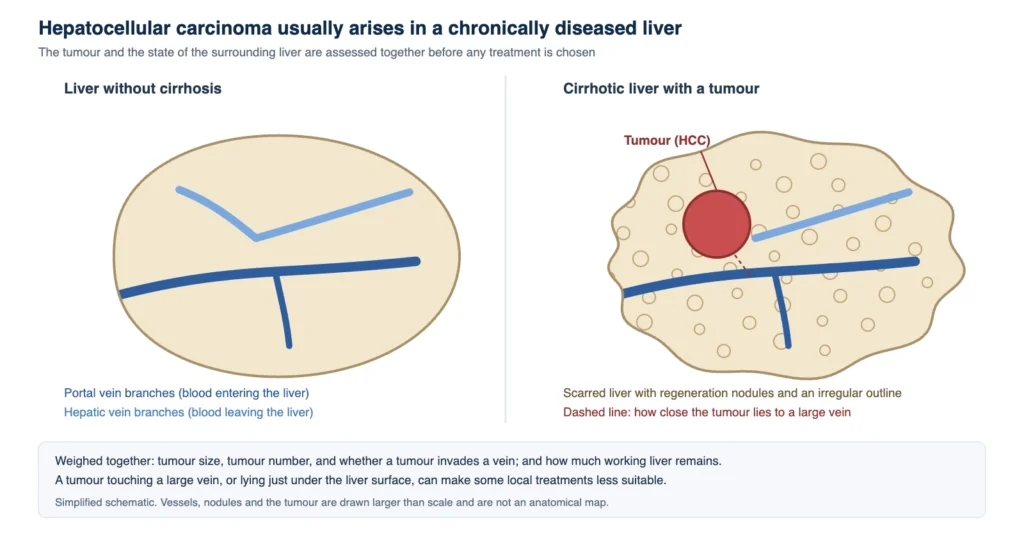 Liver cancer treatment in Korea: schematic comparing a liver without cirrhosis and a cirrhotic liver containing a hepatocellular carcinoma nodule lying close to a portal vein branch