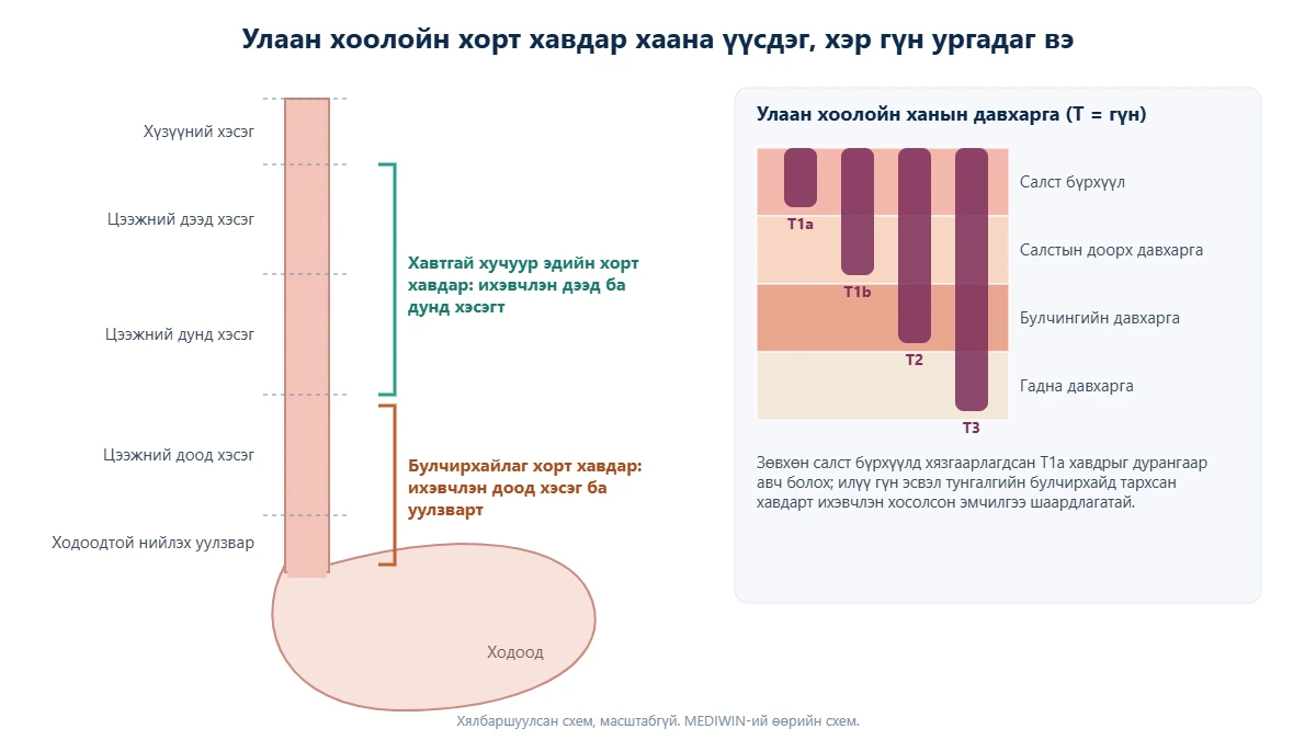 Улаан хоолойн схем: хүзүүний, цээжний дээд, дунд, доод хэсэг ба ходоодтой нийлэх уулзвар, хавтгай хучуур эдийн болон булчирхайлаг хорт хавдар ихэвчлэн үүсдэг хэсэг, T1a-аас T3 хүртэлх гүнийг тодорхойлох ханын давхарга