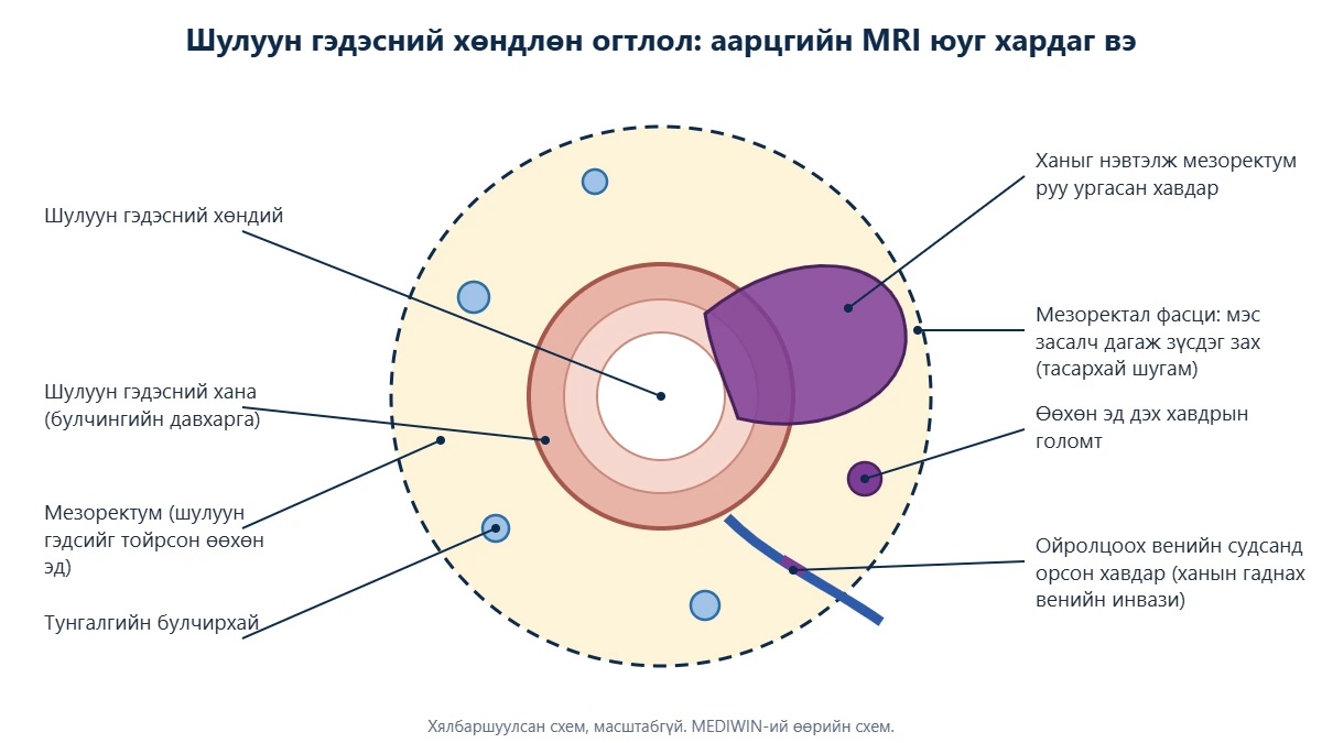 Шулуун гэдэсний хөндлөн огтлолын схем: шулуун гэдэсний хана, мезоректум, мезоректал фасци, тунгалгийн булчирхай, мезоректум руу ургасан хавдар, ханын гаднах венийн инвази