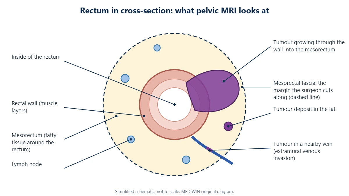 Diagram of the rectum in cross-section showing the rectal wall, mesorectum, mesorectal fascia, lymph nodes, a tumour growing into the mesorectum and extramural venous invasion