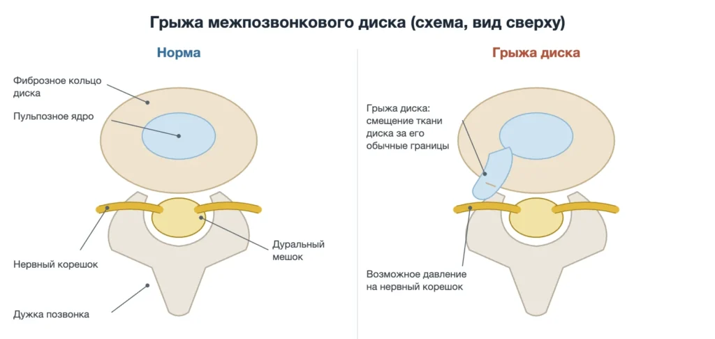 Схема: нормальный межпозвонковый диск и грыжа диска рядом с нервным корешком, вид сверху