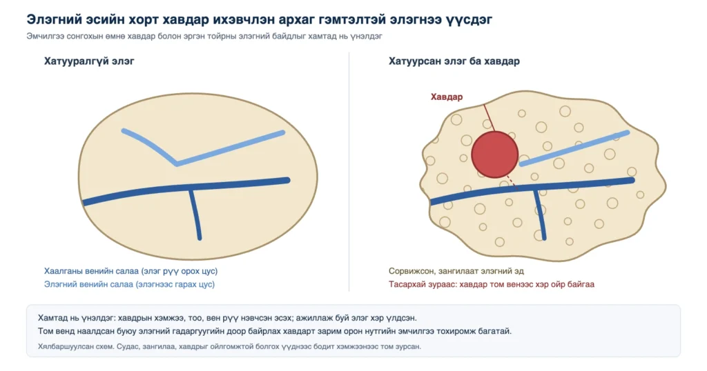 Солонгост элэгний хорт хавдрын эмчилгээ: хатууралгүй элэг ба хаалганы венийн салааны ойролцоо байрлах элэгний эсийн хорт хавдартай хатуурсан элэгний харьцуулсан схем