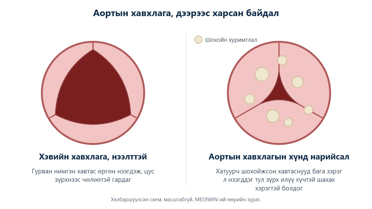 Аортын хавхлагыг дээрээс харсан схем: гурван хавтастай хэвийн нээлттэй хавхлага ба шохойжсон, хүчтэй нарийссан хавхлага