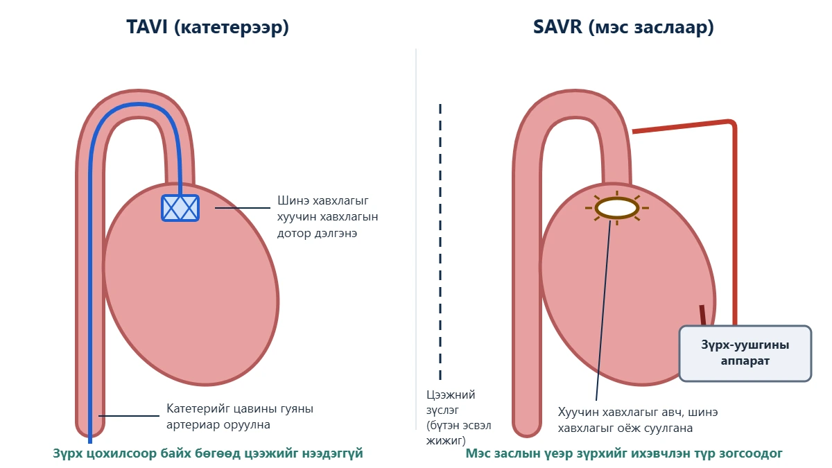 TAVI ба SAVR-ыг харьцуулсан схем: цавины артериар катетерээр шинэ хавхлагыг хуучин хавхлагын дотор байрлуулах ба цээжний зүслэг, зүрх-уушгины аппарат ашиглан хавхлагыг оёж суулгах